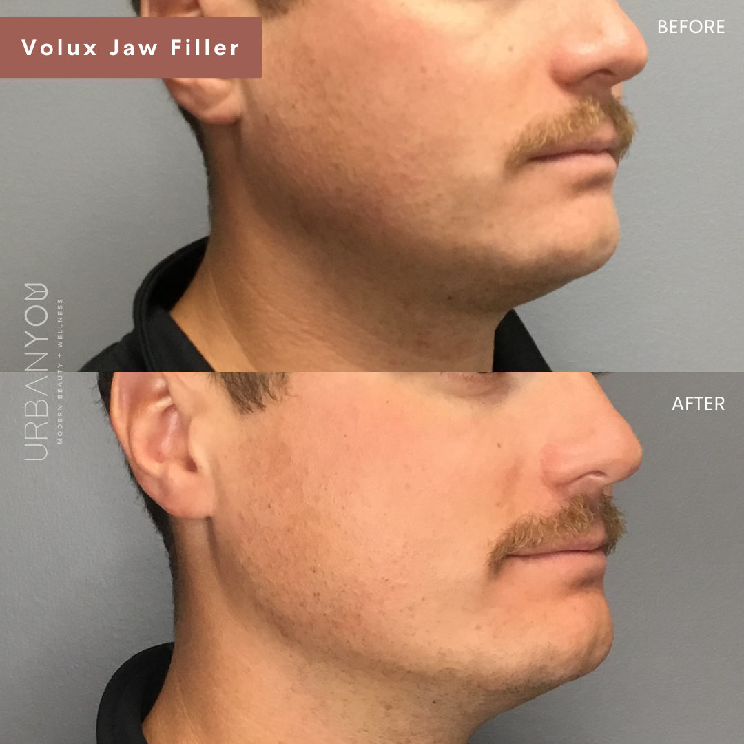 Men's Juvéderm Volux Jaw Filler before &amp; after photo at Urban You medical spa in Grand Rapids, Northville, and Rockford, MI