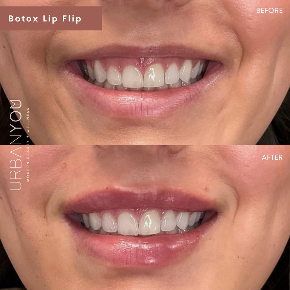 Botox Lip Flip before and after photo at Urban You, Michigan's #1 medical spa in Grand Rapids, Northville, and Rockford, Michigan