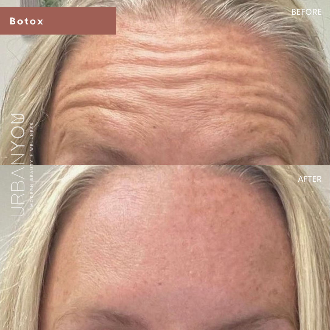 Botox for forehead winkles before and after photo at Urban You, Michigan's #1 medical spa in Grand Rapids, Northville, and Rockford, Michigan