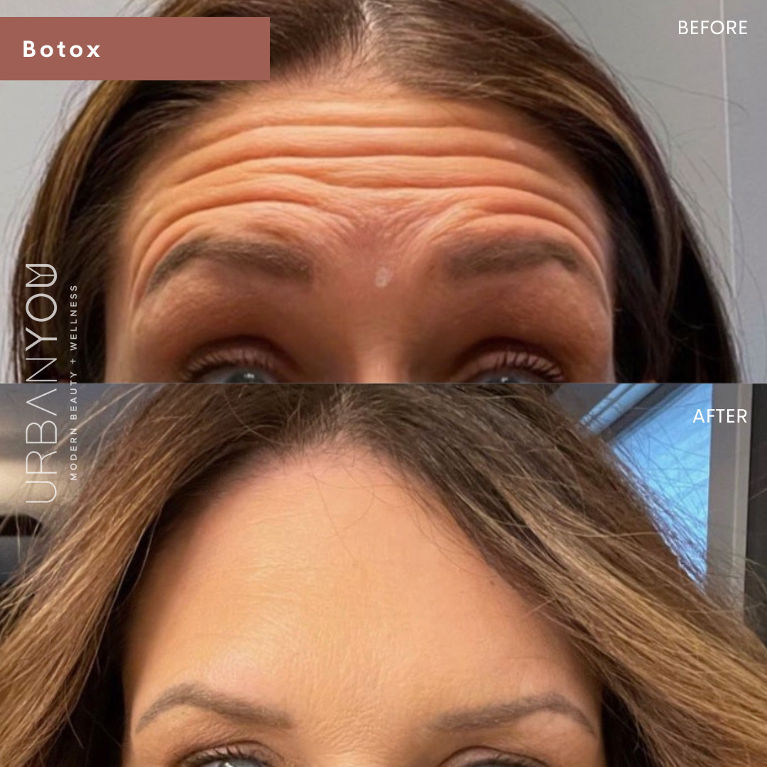 Botox for forehead winkles before and after photo at Urban You, Michigan's #1 medical spa in Grand Rapids, Northville, and Rockford, Michigan