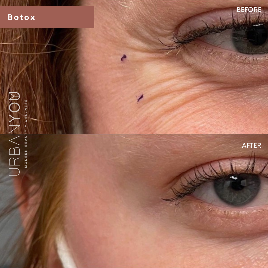 Botox for crow's feet before and after photo at Urban You, Michigan's #1 medical spa in Grand Rapids, Northville, and Rockford, Michigan