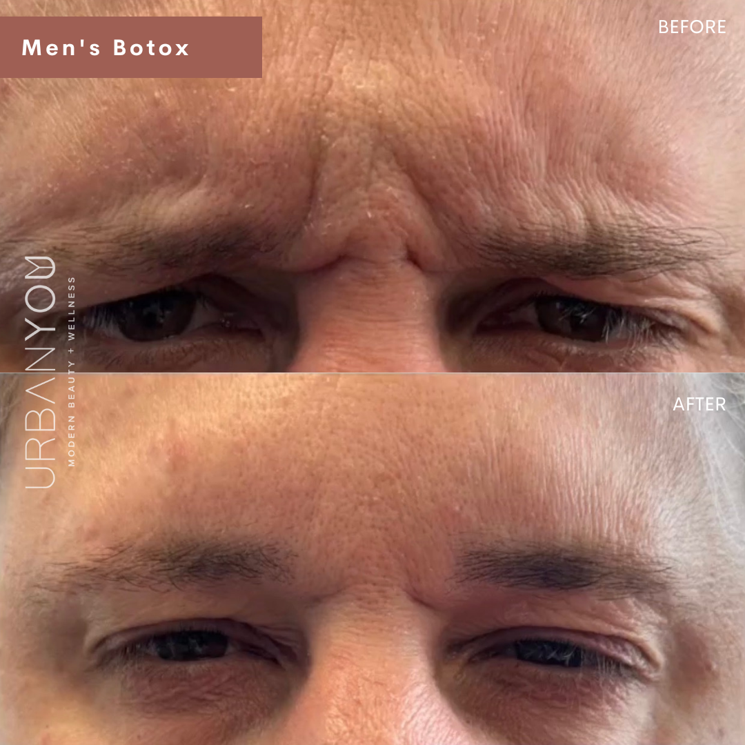 Men's Botox for forehead winkles before and after photo at Urban You, Michigan's #1 medical spa in Grand Rapids, Northville, and Rockford, Michigan