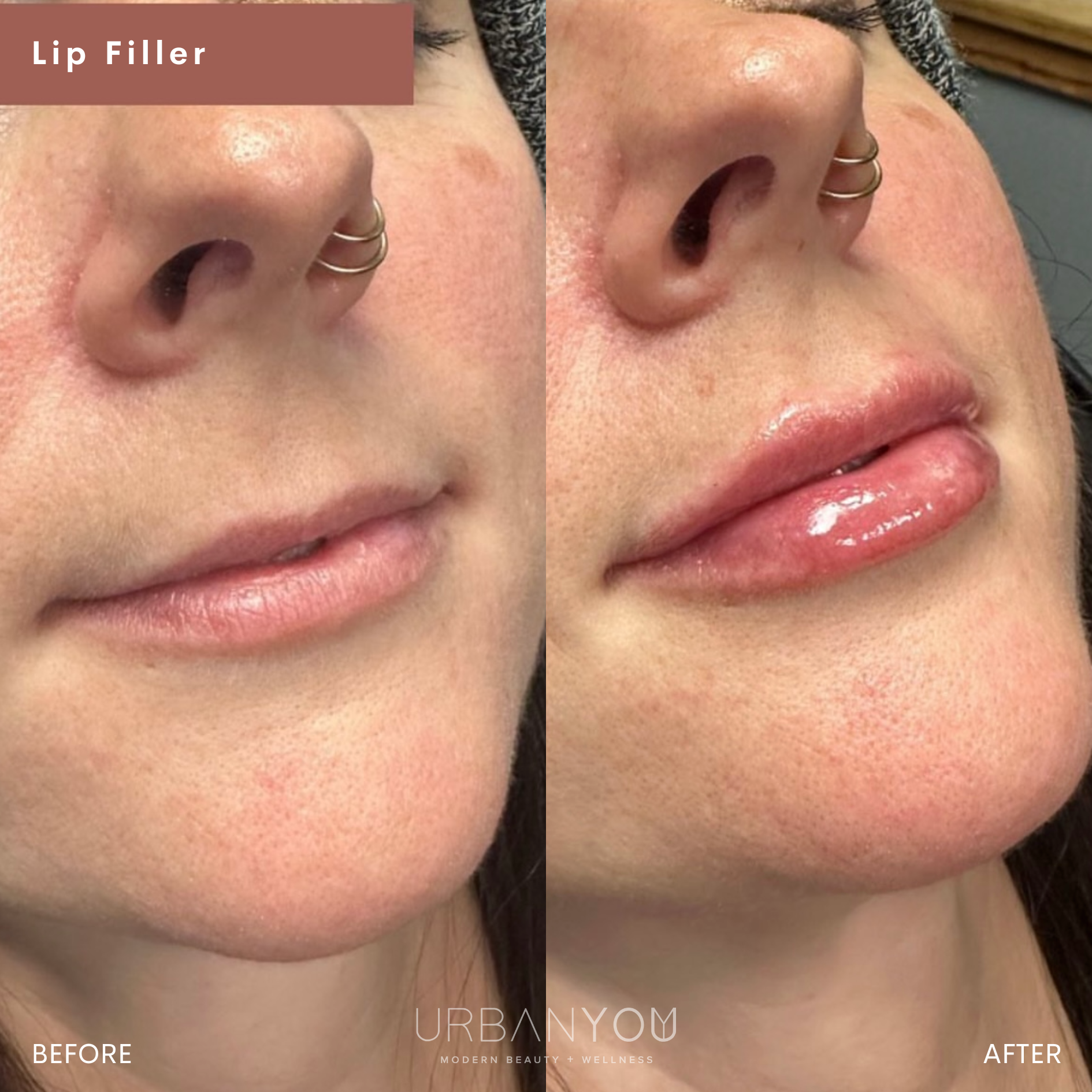 Juvéderm lip filler Before and After Photo