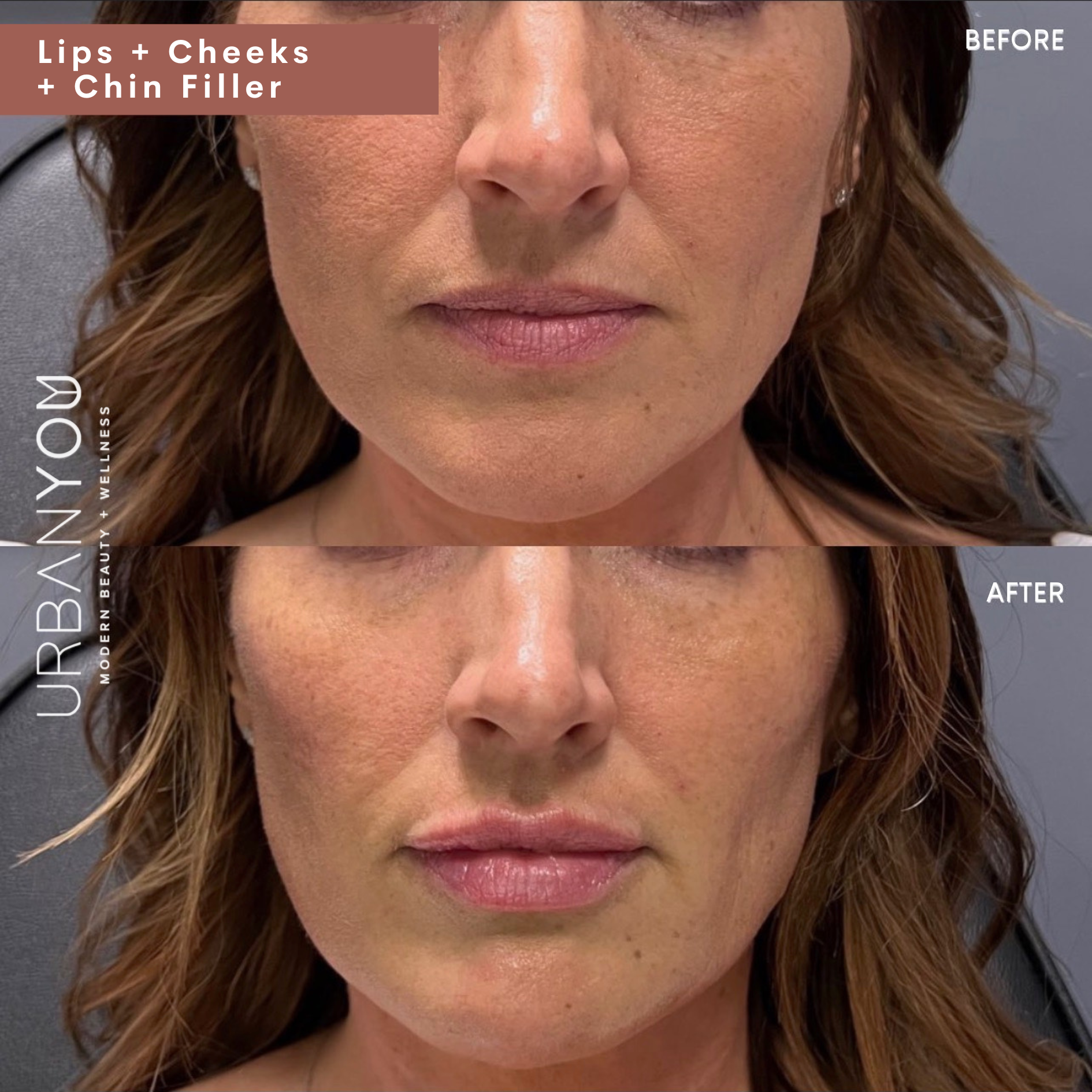 Juvéderm cheek and chin filler Before and After Photo