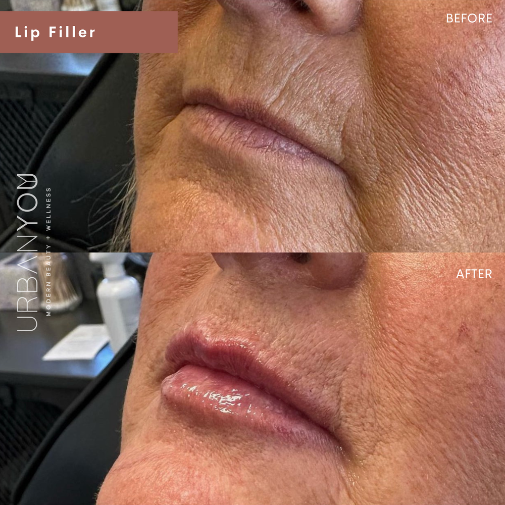 Juvéderm lip filler Before and After Photo