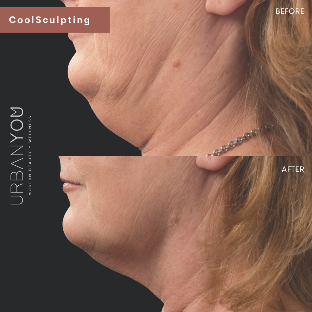 CoolSculpting for double chin Before and After Photo