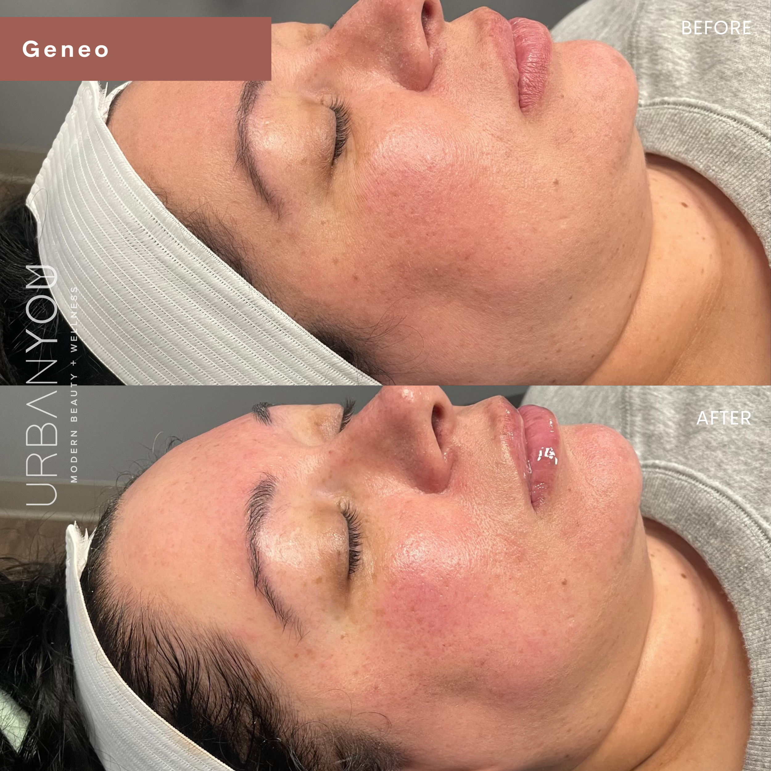 Glo2Facial / OxyGeneo before and after photo at Urban You medical spa