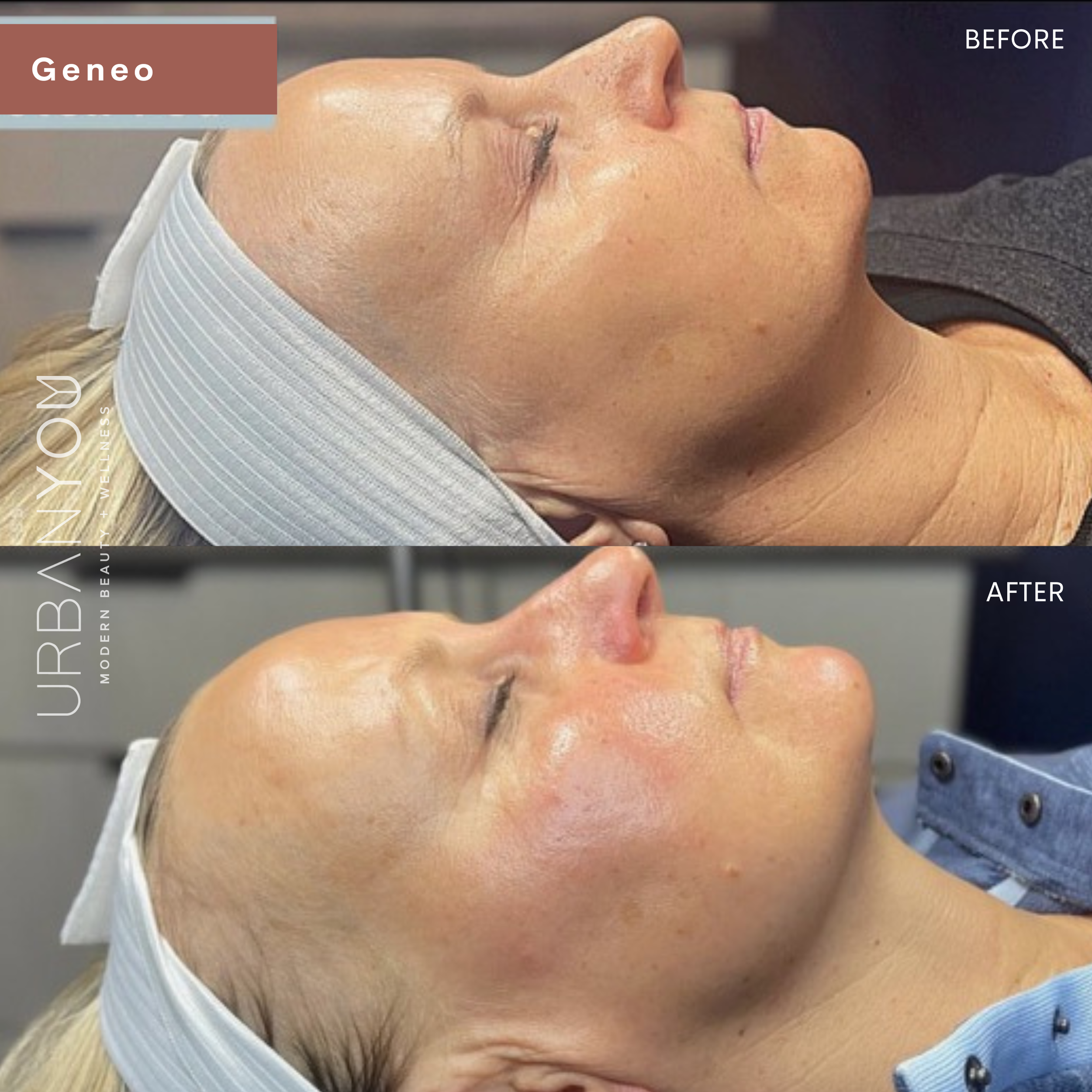 Glo2Facial / OxyGeneo before and after photo at Urban You medical spa