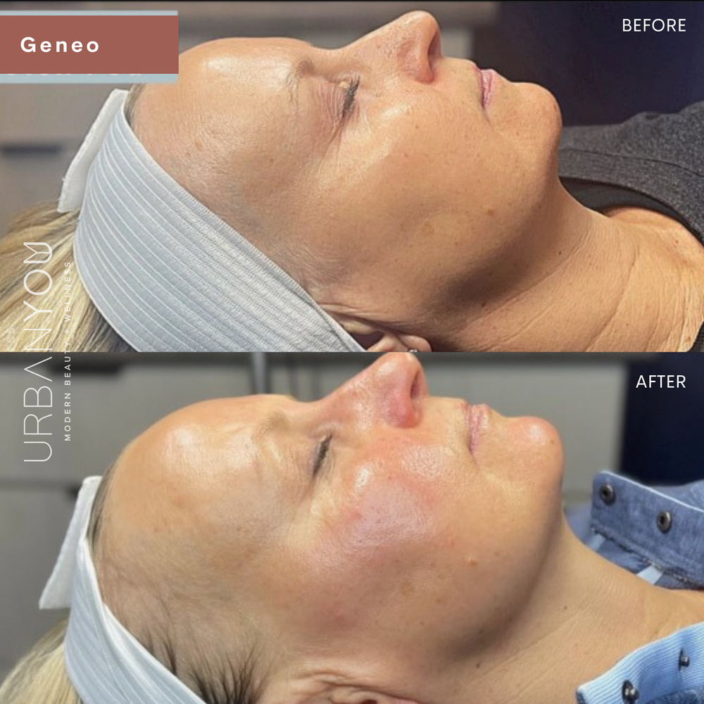 Glo2Facial / OxyGeneo before and after photo at Urban You medical spa (Copy)