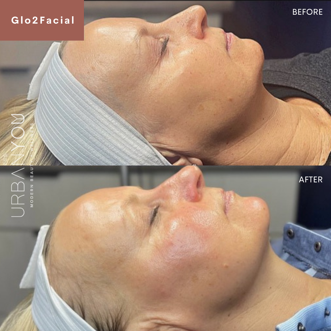 Glo2Facial Before &amp; After Photo at Urban You Medical Spa