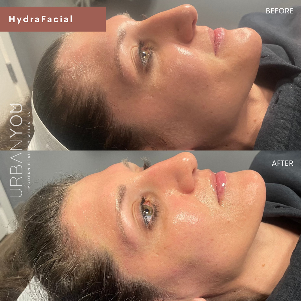 HydraFacial before and after photo at Urban You, the best medical spa in Michigan