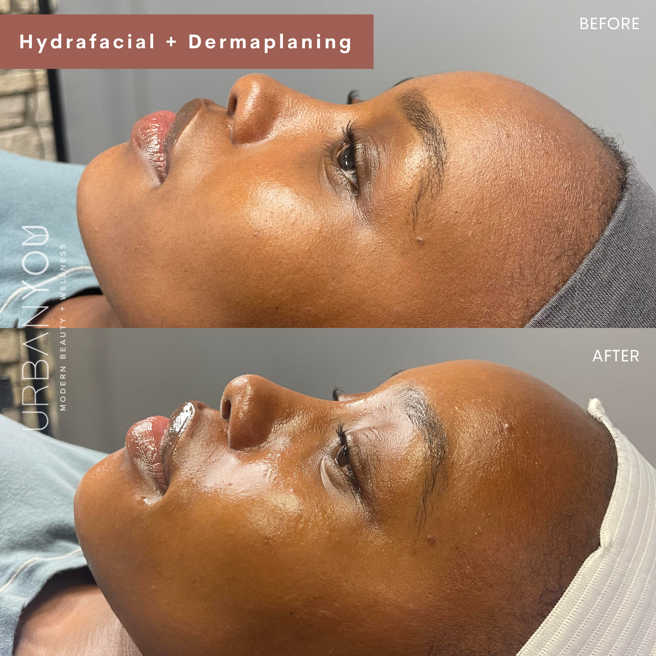 HydraFacial before and after photo at Urban You, the best medical spa in Michigan