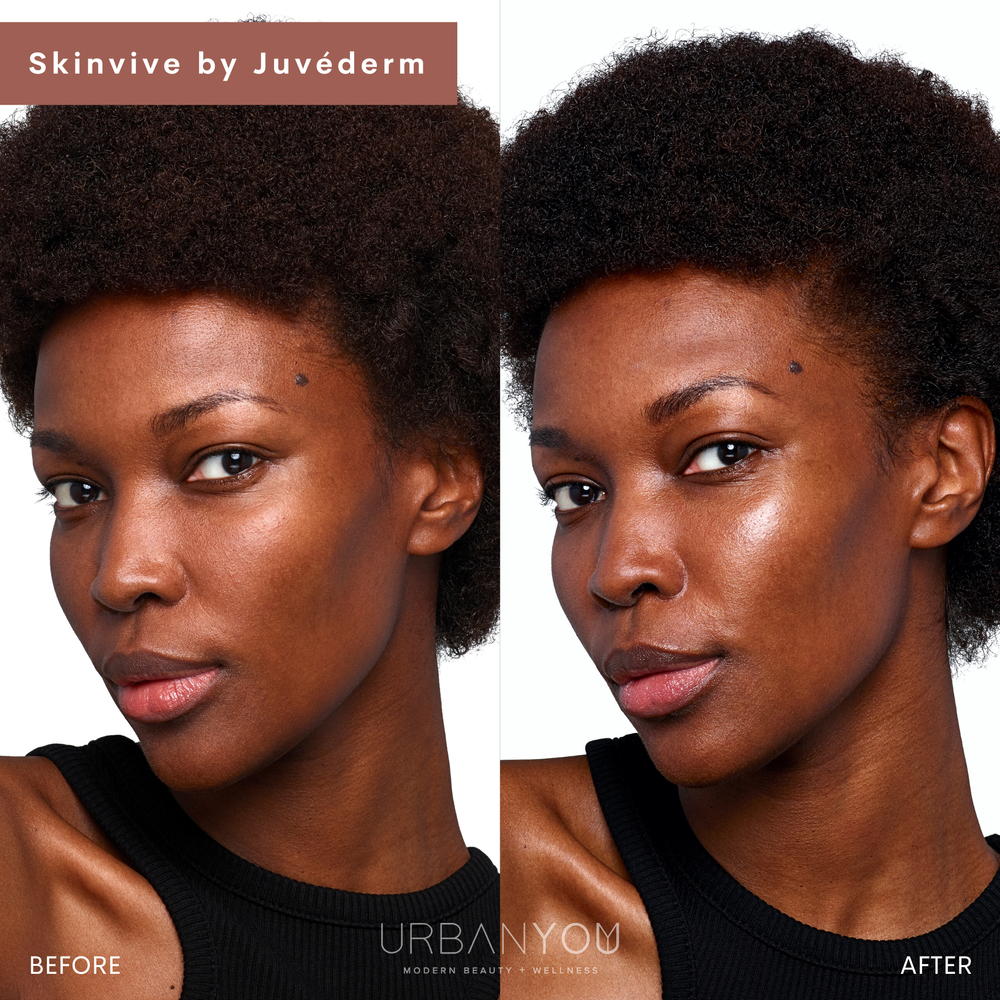 SkinVive by Juvéderm before and after photo at Urban You medical spa in Grand Rapids and Northville, michigan
