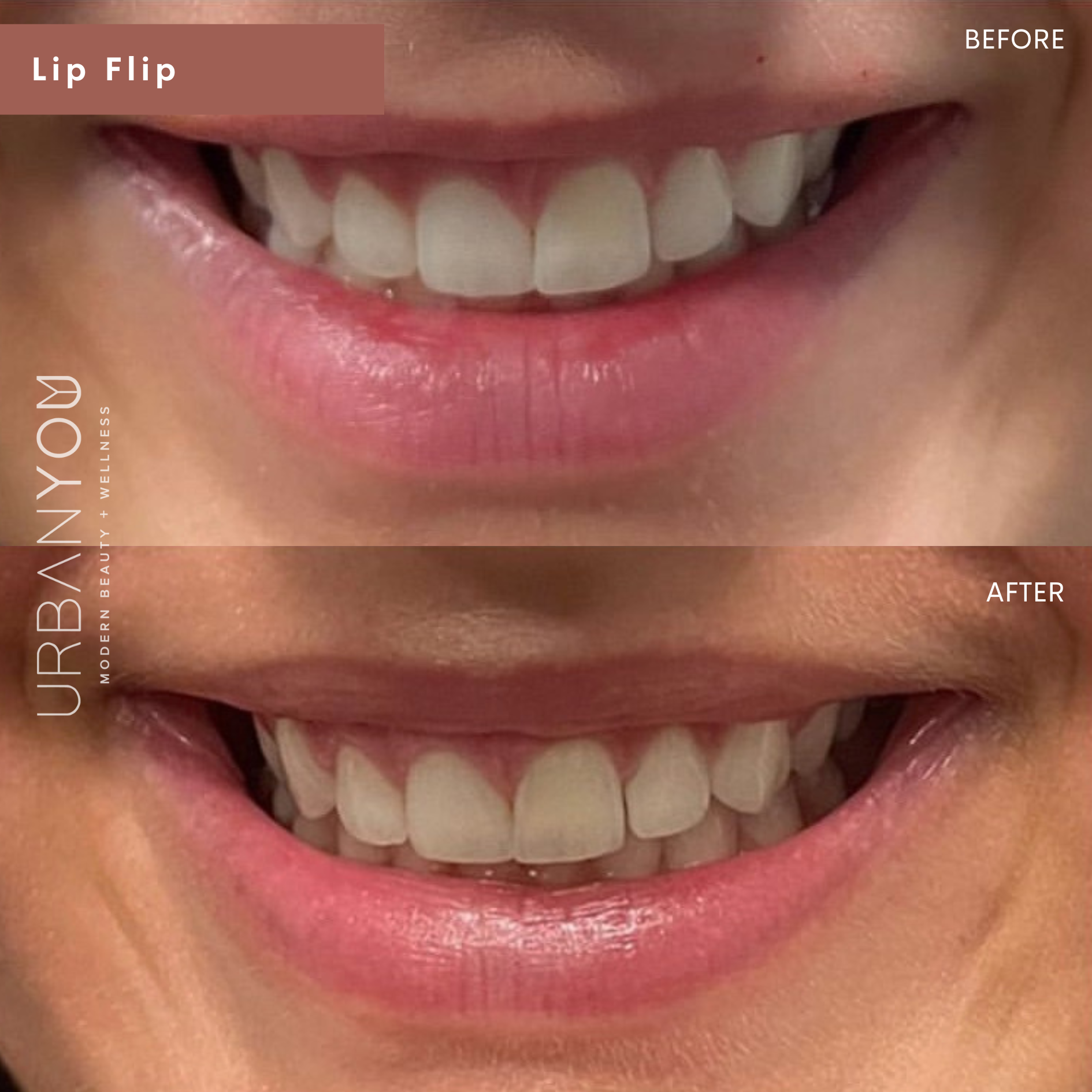 Lip flip with botox cosmetic before and after photo at urban you medical spa in northville and grand rapids michigan