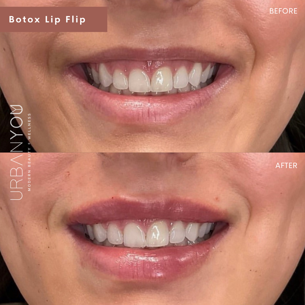 Lip flip with botox cosmetic before and after photo at urban you medical spa in northville and grand rapids michigan (Copy)