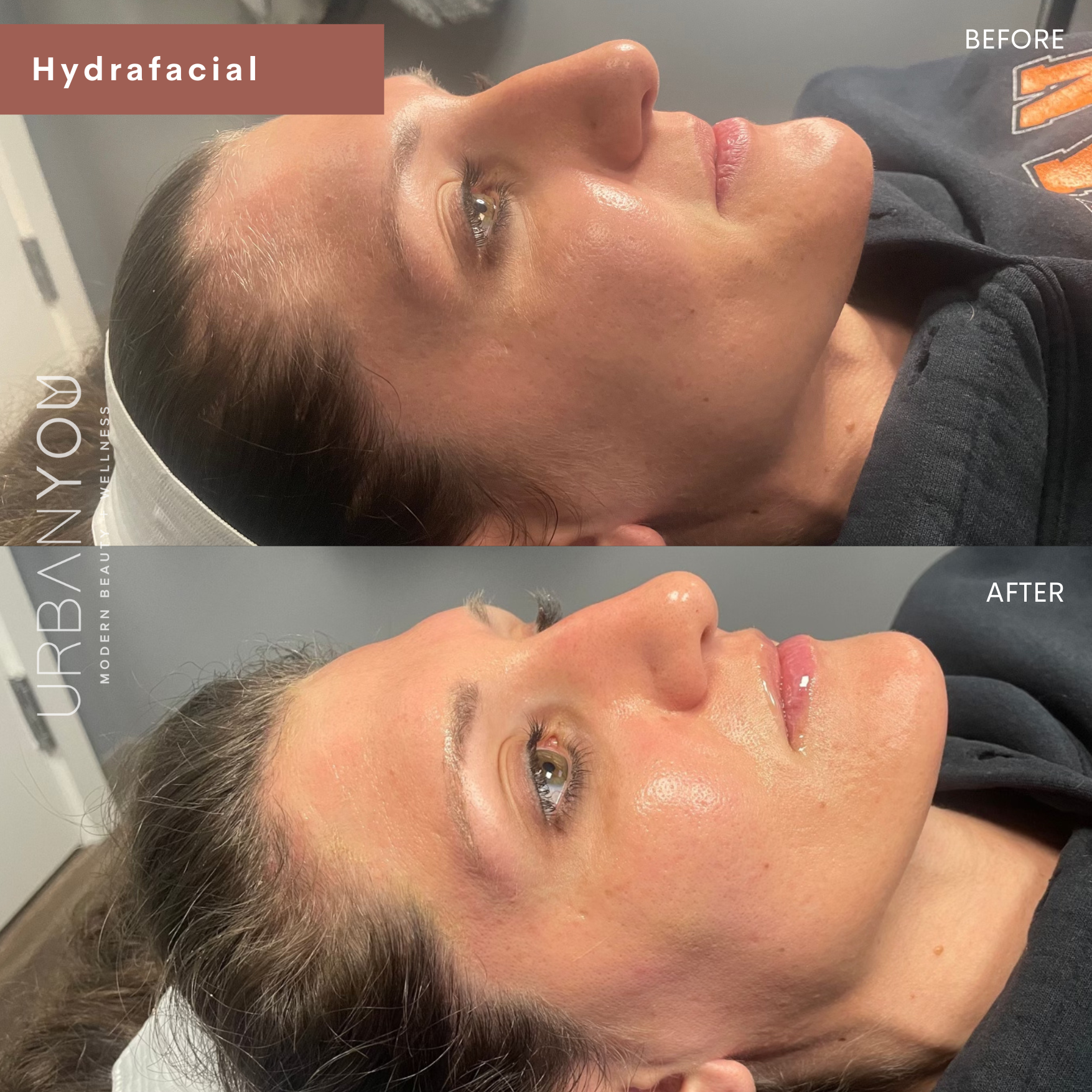 Hydrafacial before and after photo at urban you medical spa in grand rapids and northville, michigan