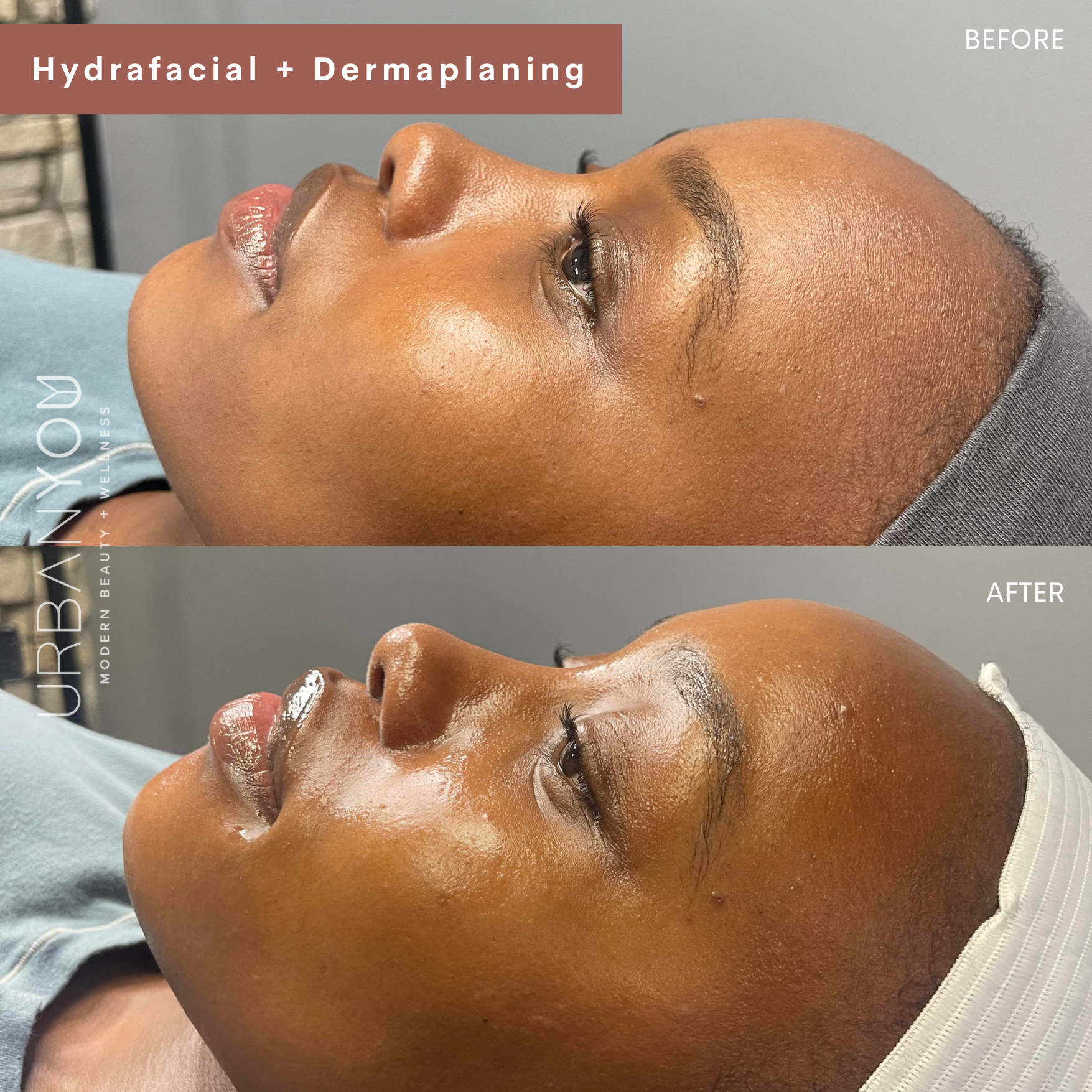 Hydrafacial before and after photo at urban you medical spa in grand rapids and northville, michigan