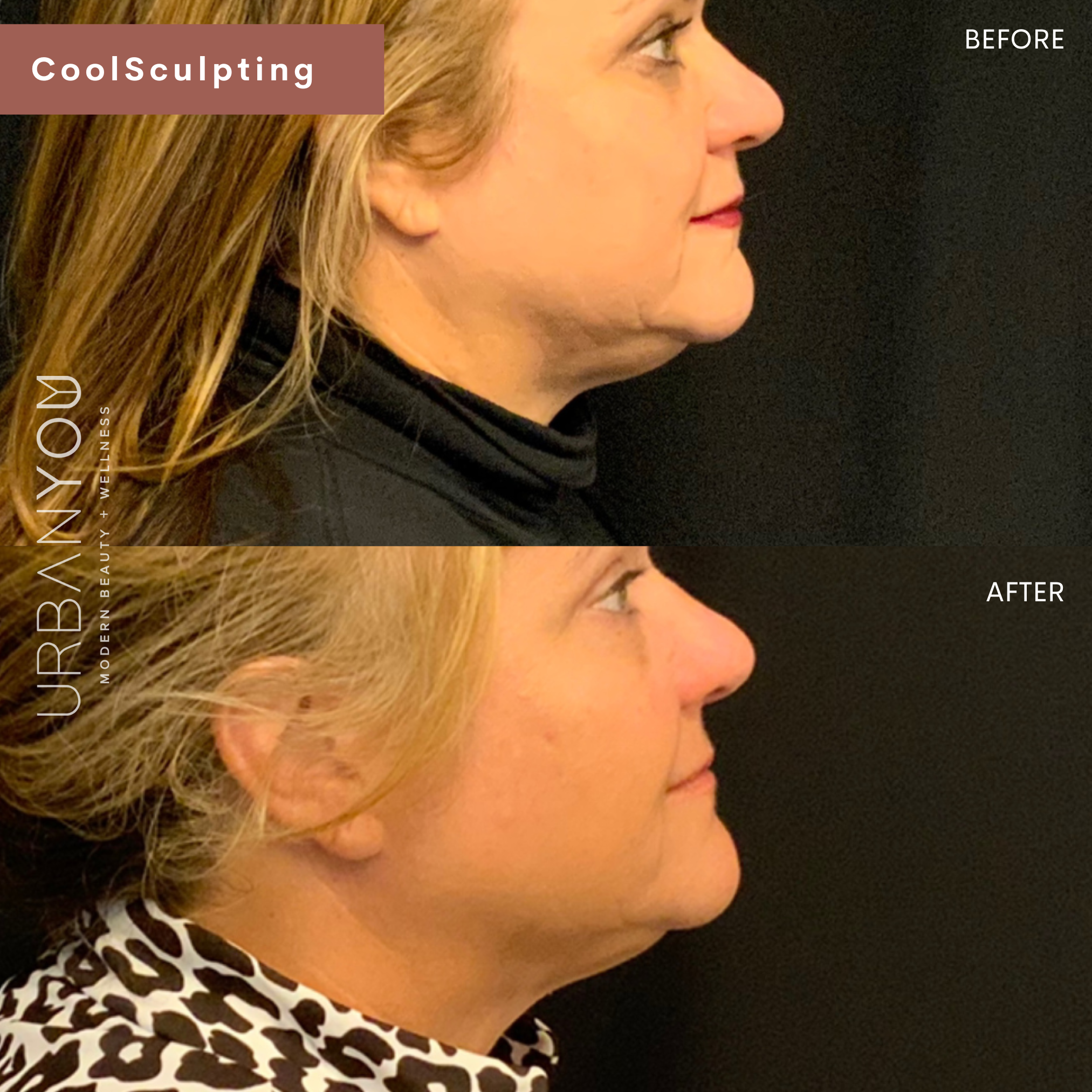 CoolSculpting Before and After Photos at Urban You Medical Spa in Grand Rapids and Northville, Michigan