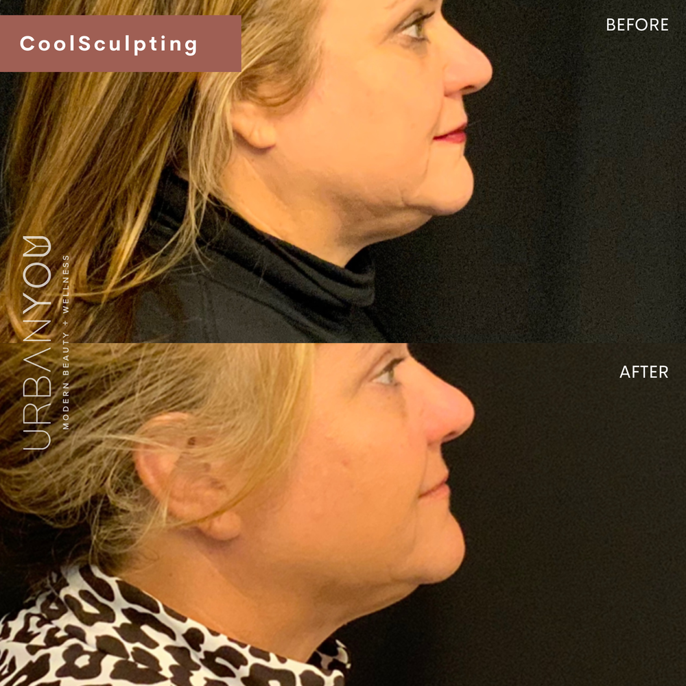 CoolSculpting Before and After Photos at Urban You Medical Spa in Grand Rapids and Northville, Michigan (Copy)