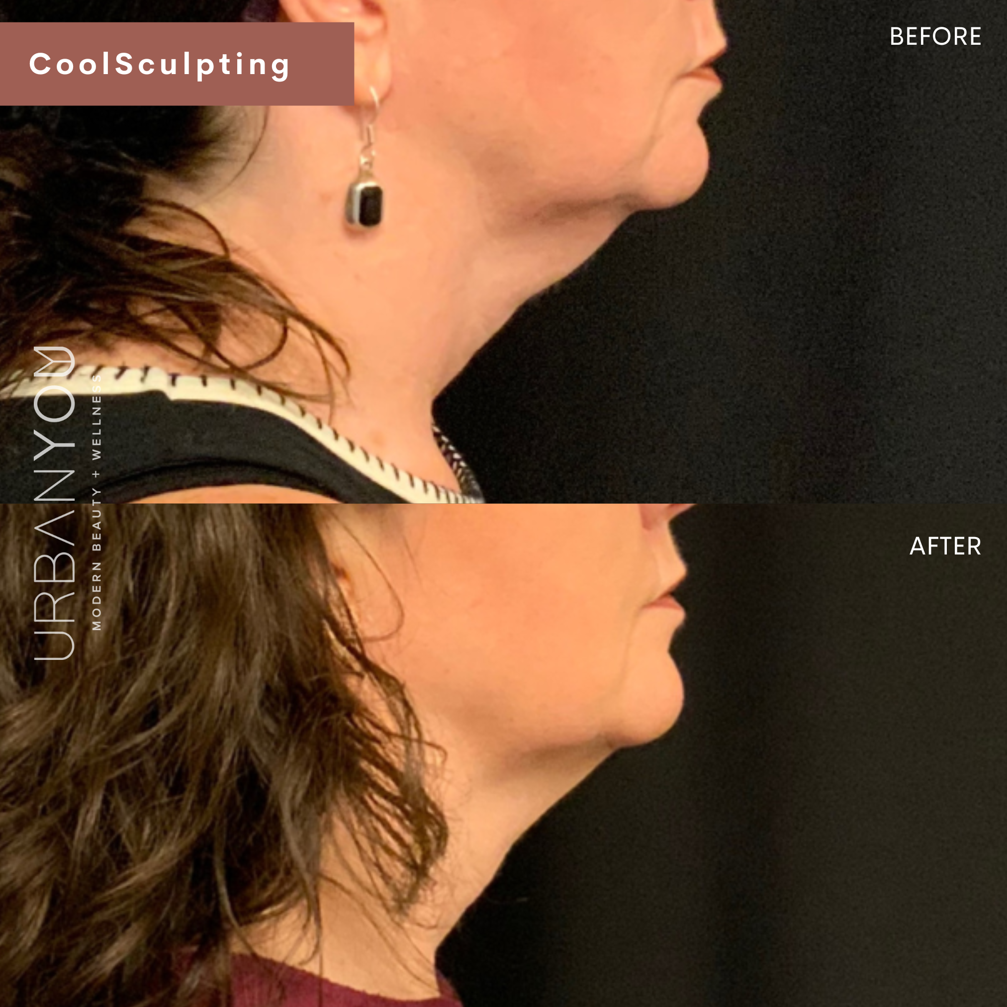 CoolSculpting Before and After Photos at Urban You Medical Spa in Grand Rapids and Northville, Michigan (Copy)