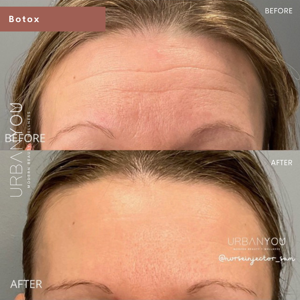 Botox Forehead Before &amp; After Photo