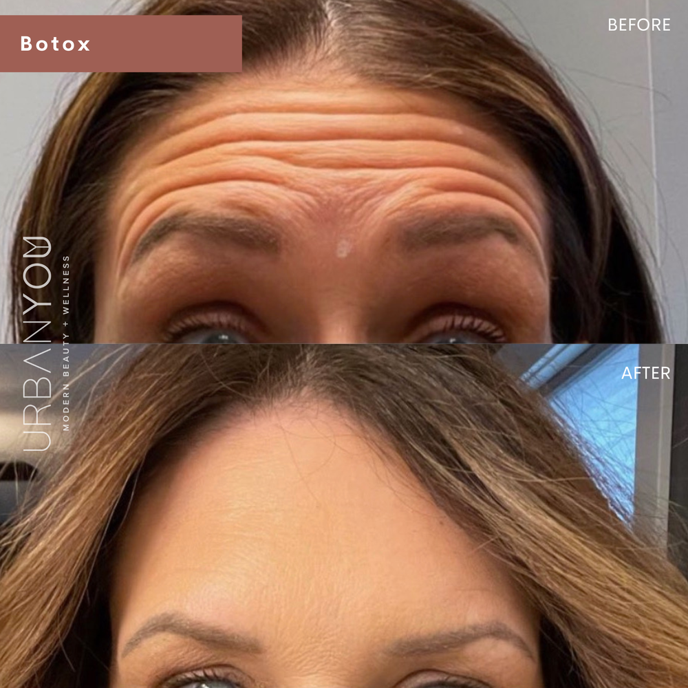 Botox for Forehead Before and After