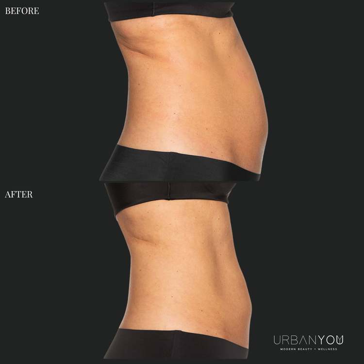 CoolSculpting Before and After