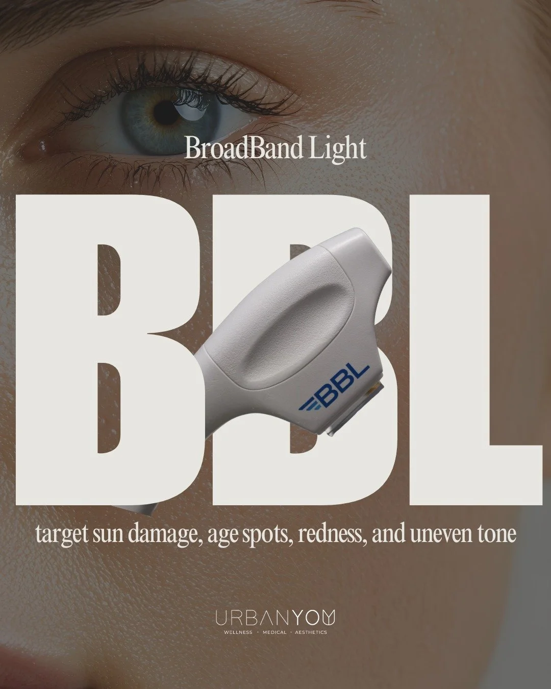 📸 The proof is in the pictures.

BBL (BroadBand Light) is one of the most powerful tools we use to reverse visible sun damage and restore skin clarity. Using light energy, BBL targets:
✔ Brown spots + pigmentation
✔ Redness + broken capillaries
✔ Un