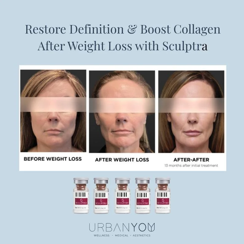 Have you noticed changes in facial fullness after weight loss with GLP-1 medications like Semaglutide or Tirzepatide? Rapid or significant weight loss can reduce subcutaneous fat and collagen support, making the face appear less defined over time.

R