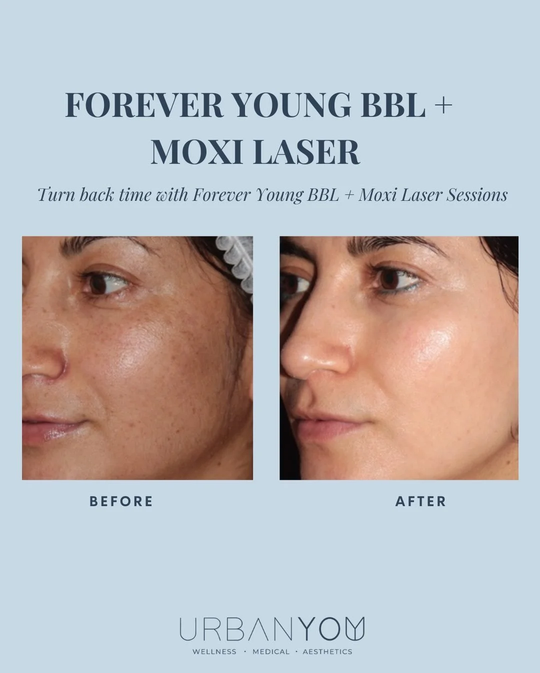 New year. New skin journey.
BBL + MOXI.

This advanced laser combination targets the layers of skin responsible for aging&mdash;improving what you see now while supporting healthier skin over time.

✨ BBL helps improve sun damage, redness, and uneven