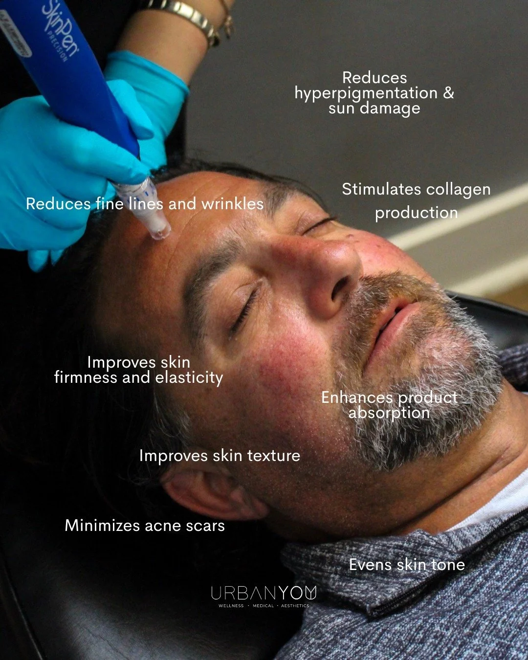 SkinPen Microneedling is a gold-standard treatment for improving skin quality over time. By stimulating collagen and accelerating cell turnover, it helps improve texture, tone, acne scarring, fine lines, and overall skin quality.

Book your consult t