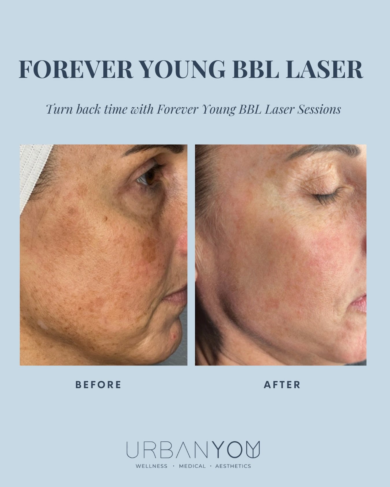 Turn back time with the Forever Young BBL Laser ✨ 

This isn&rsquo;t just another facial treatment &mdash; it&rsquo;s one of the most advanced light therapies available for actually reversing visible signs of aging at the cellular level. 

Forever Yo