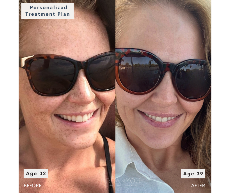 Side-by-side comparison photo of a woman. The left shows her before with freckles, light skin, and dark sunglasses, labeled "Age 32" and "BEFORE." The right shows her after with fewer freckles, smoother skin, and larger sunglasses, labeled "Age 39" and "AFTER." A text overlay at the top says "Personalized Treatment Plan."