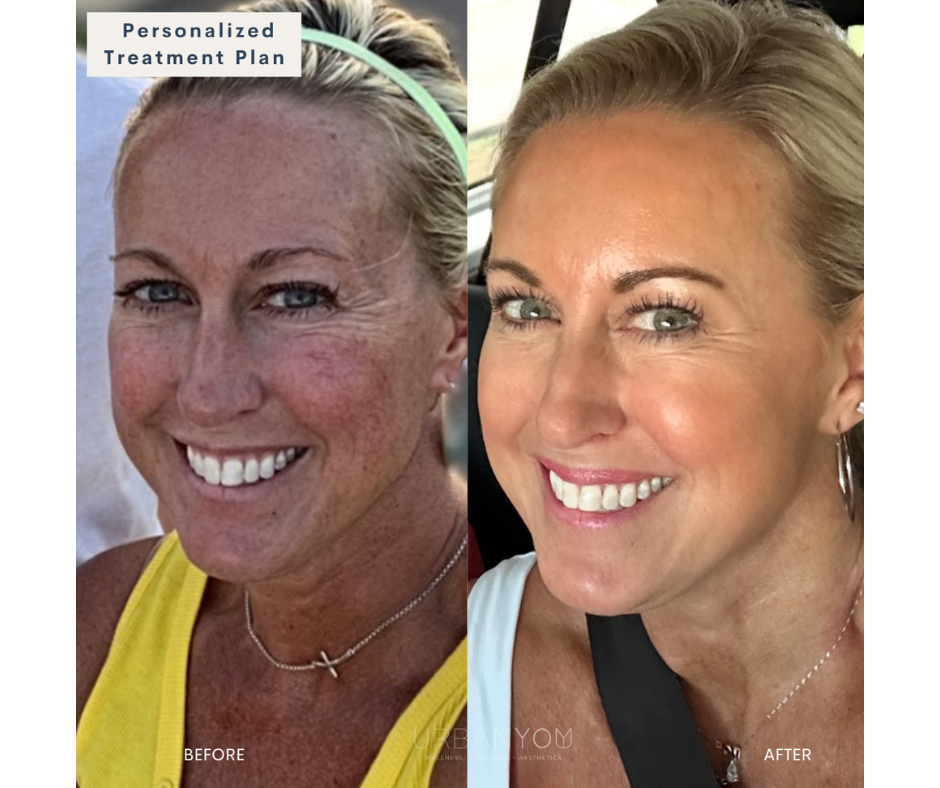 Side-by-side comparison of a woman's face before and after skincare treatment. The 'before' shows her with freckles, redness, and uneven skin tone; the 'after' shows clear, smooth, and evenly toned skin with a bright smile.