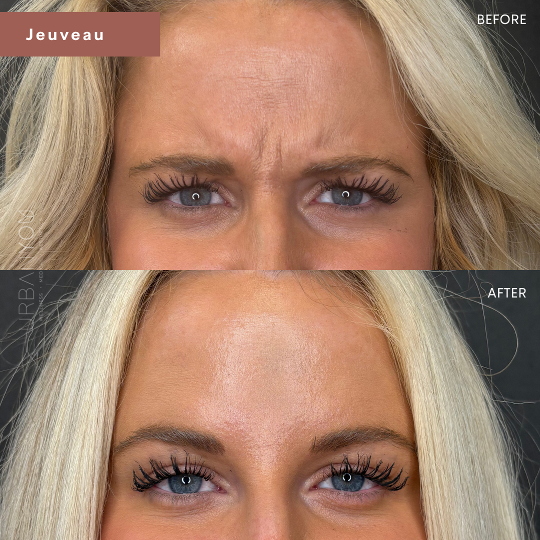 Close-up of a woman's forehead and eyes showing a before and after comparison of a cosmetic treatment. The 'before' image shows visible forehead lines and wrinkles, while the 'after' image shows a smoother, more youthful forehead with reduced lines.