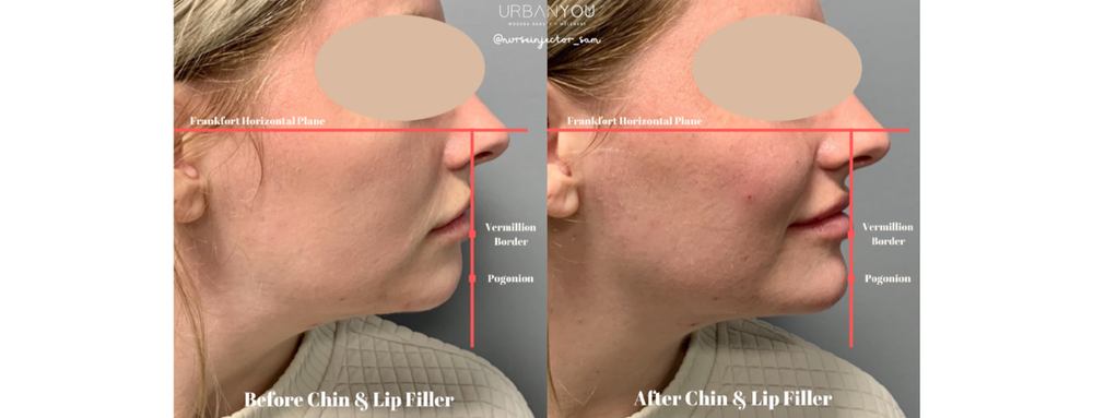 the-secret-to-achieving-the-perfect-profile-balancing-the-chin-and