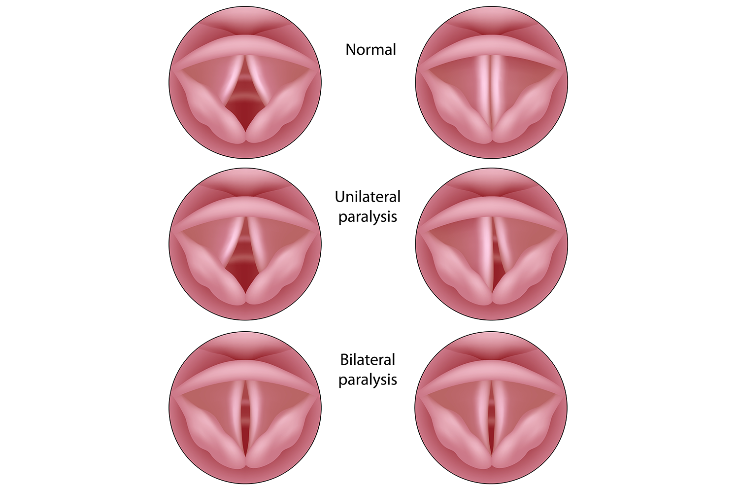 Laryngeal paralysis.png