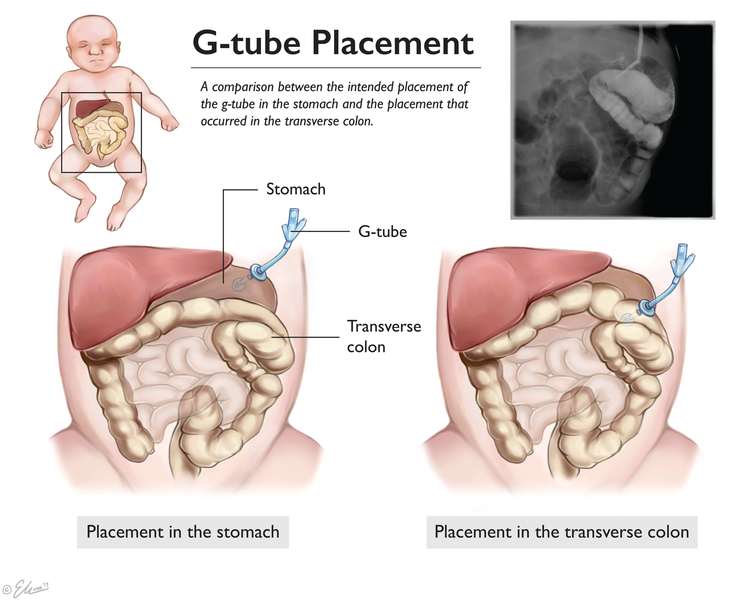 G-tube Placement