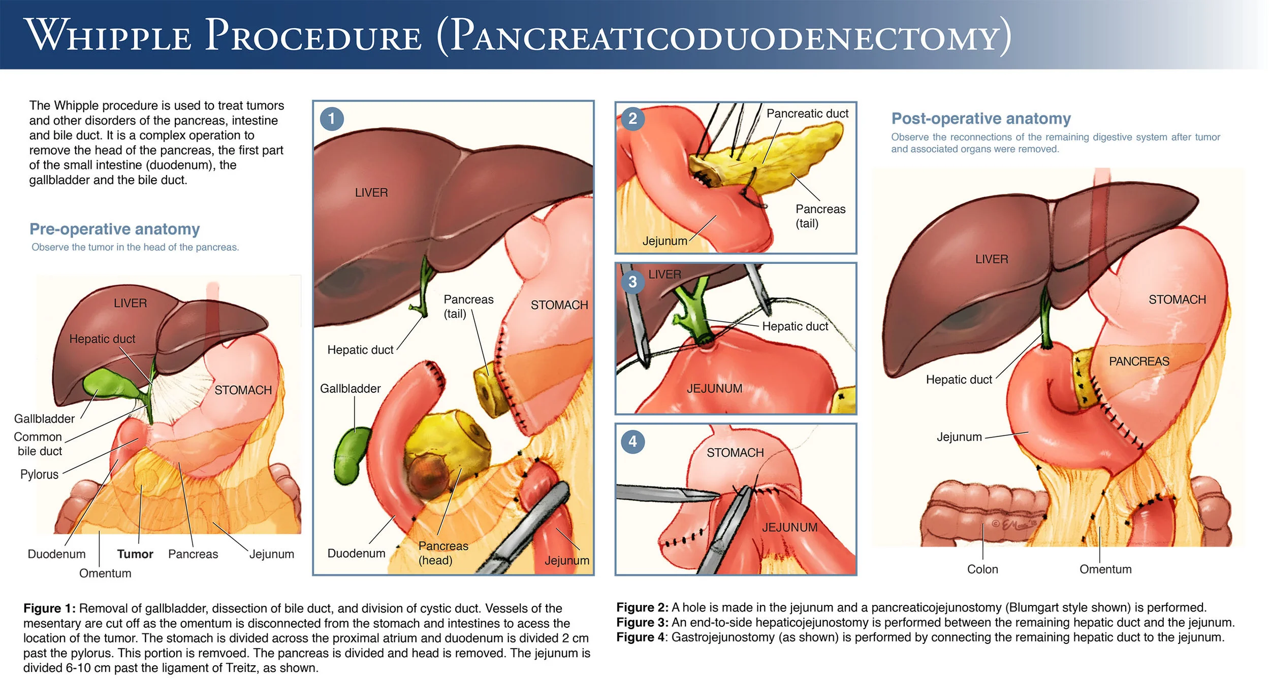 Whipple Procedure