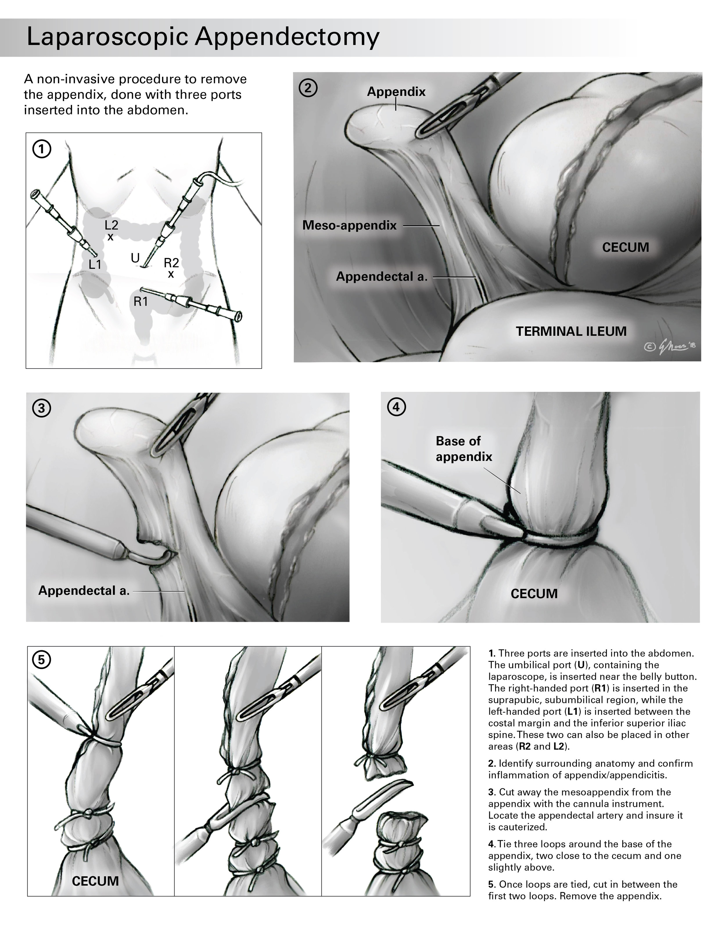 Laparoscopic Appendectomy