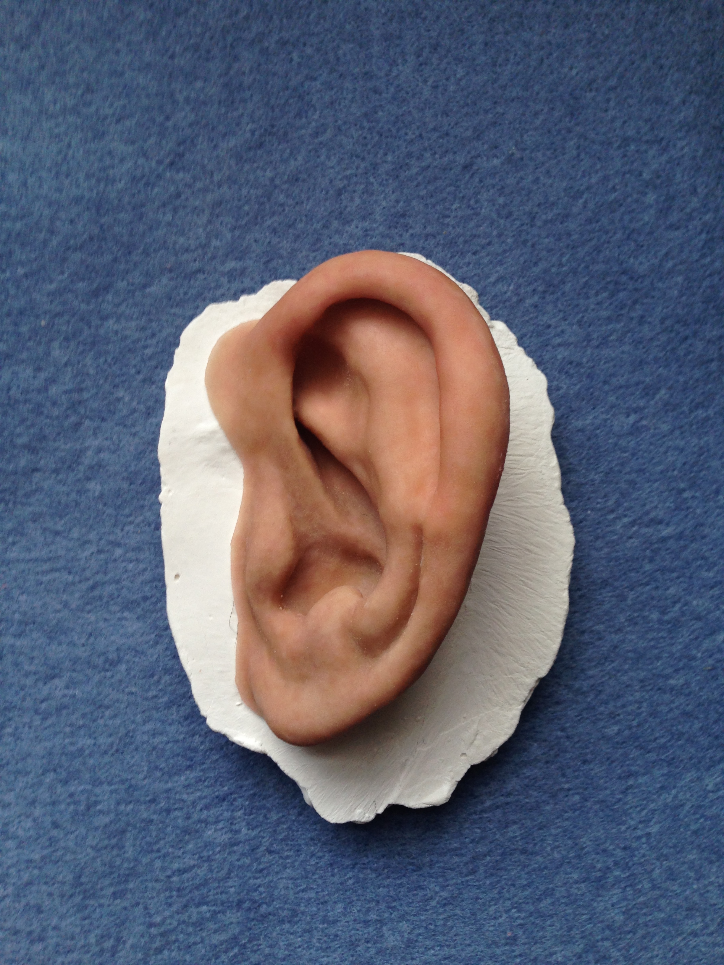 Ear Prosthesis