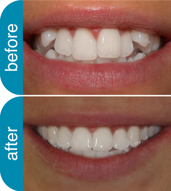 Clear Braces — Dentist Melbourne  Invisalign + Teeth Whitening + Clear  Braces