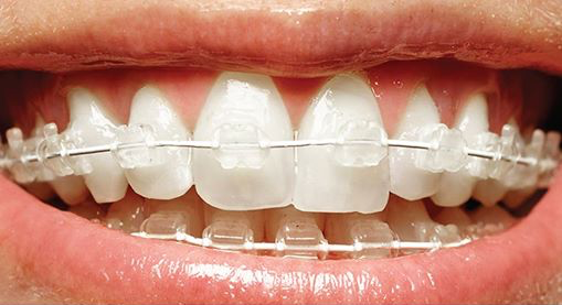 Straighten Teeth Dentist Melbourne Invisalign Teeth Whitening Clear Braces
