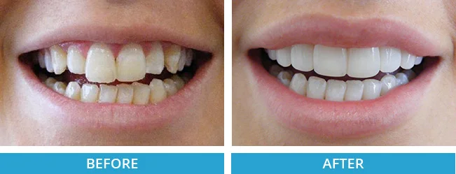 composite veneers before and after.jpg