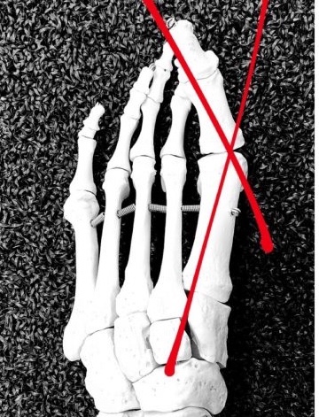 Talking Bunions with The Barefoot Podiatrist