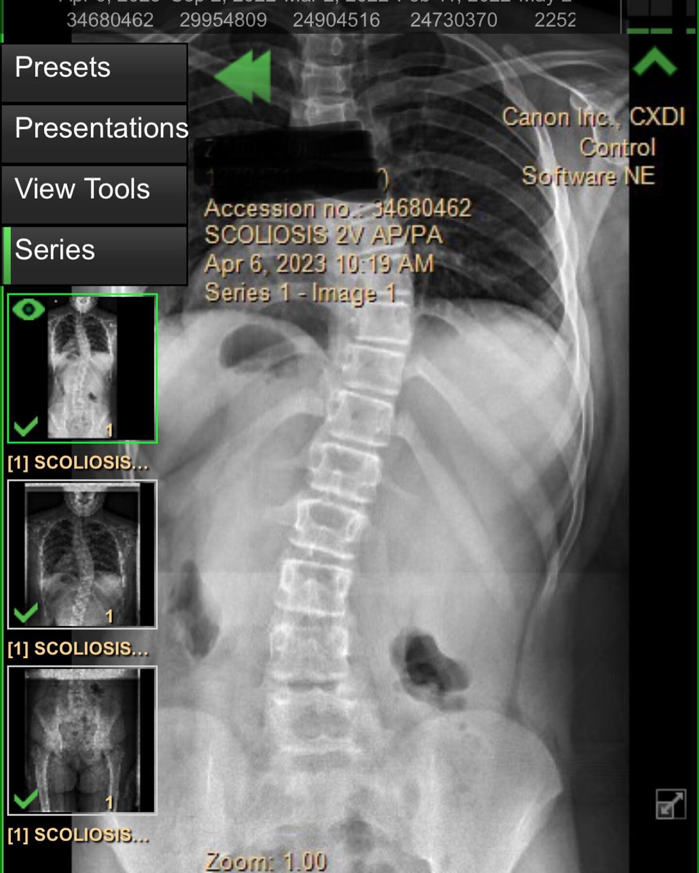 Before and After ! AIS Adolescent Idiopathic Scoliosis. The benefits of wearing a custom Boston style scoli brace. 

#scoliosis #scoli #scolibrace #scoliawareness #custommade #medical #orthoticsandprosthetics #patientcare #oandp #longisland #bronx #q