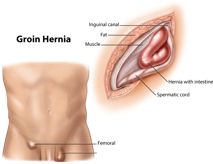Ogden Inguinal Hernia Repair, Treatment & Surgery