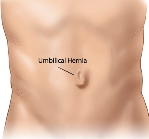 abdominal hernia in adults