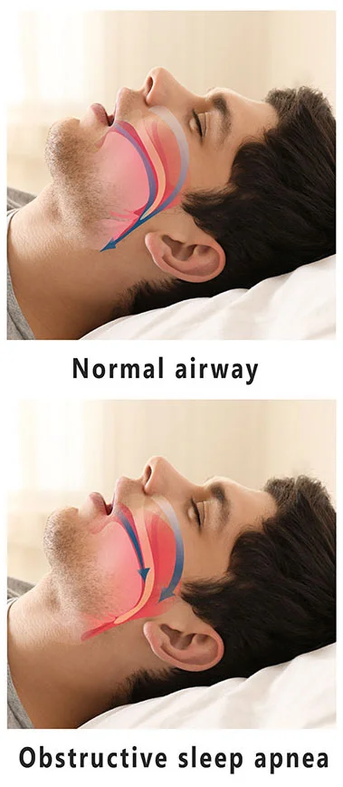 Obstructed-Sleep-Apnea.jpg