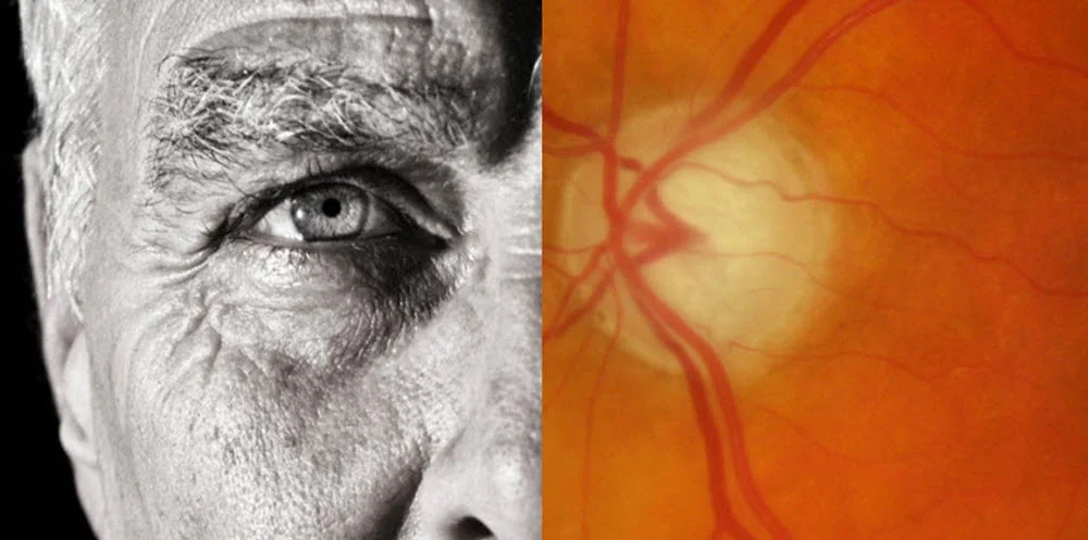Glaucoma & Retinal Disease